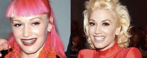 Metal Mouth! Throwback Photos of Celebs Before & After Braces